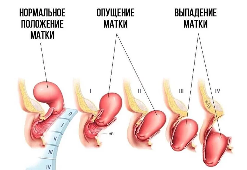 Методы тренировки мышц тазового дна для контроля над мочеиспусканием